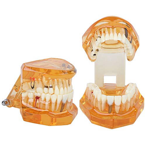 צבע כתום אחד, לימוד נשלף לימוד שיניים מודל שיניים שיניים 1 מחלת שיניים מחלת שיניים דגם בית ספר אוראלי שיניים