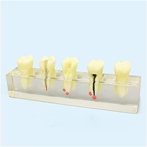 מודל עששת שיניים של KH66Zky, מודל שיני שיניים, מודל טיפול בשורש שורש אוראלי מדומה לחינוך לרופא-חולה